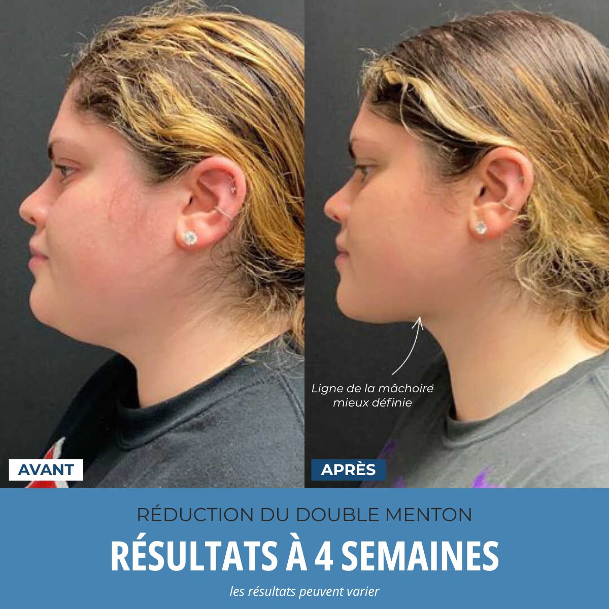 LumoSkyn Pro 2™ - Sculpteur Visage et Cou