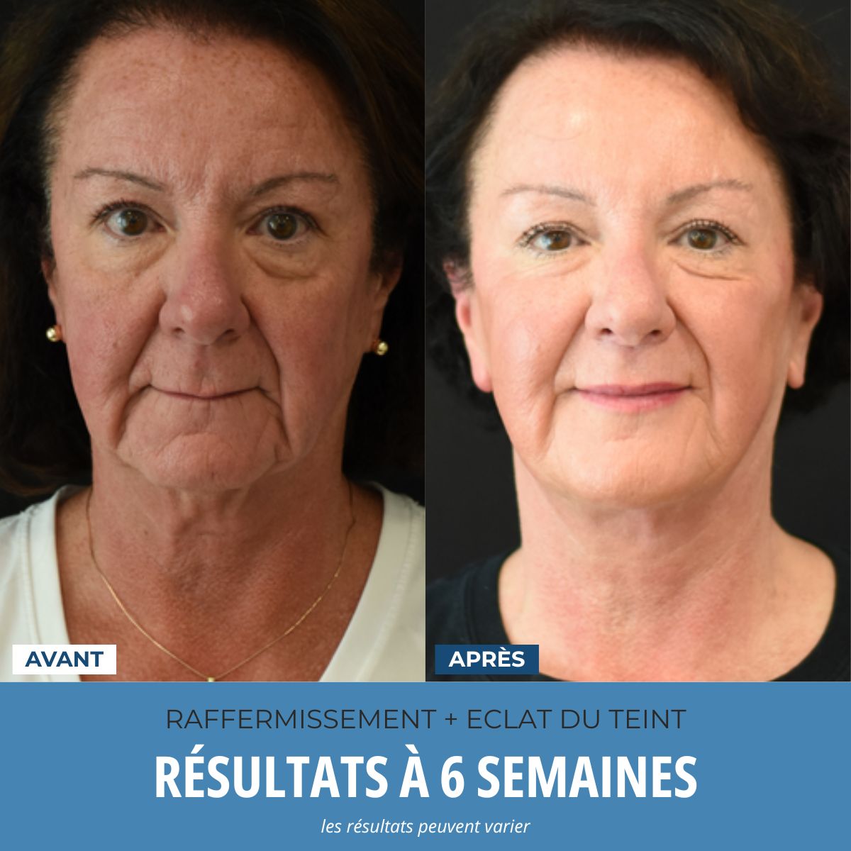LumoSkyn Pro 2™ - Sculpteur Visage et Cou
