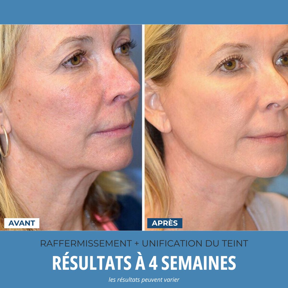 LumoSkyn Pro 2™ - Sculpteur Visage et Cou