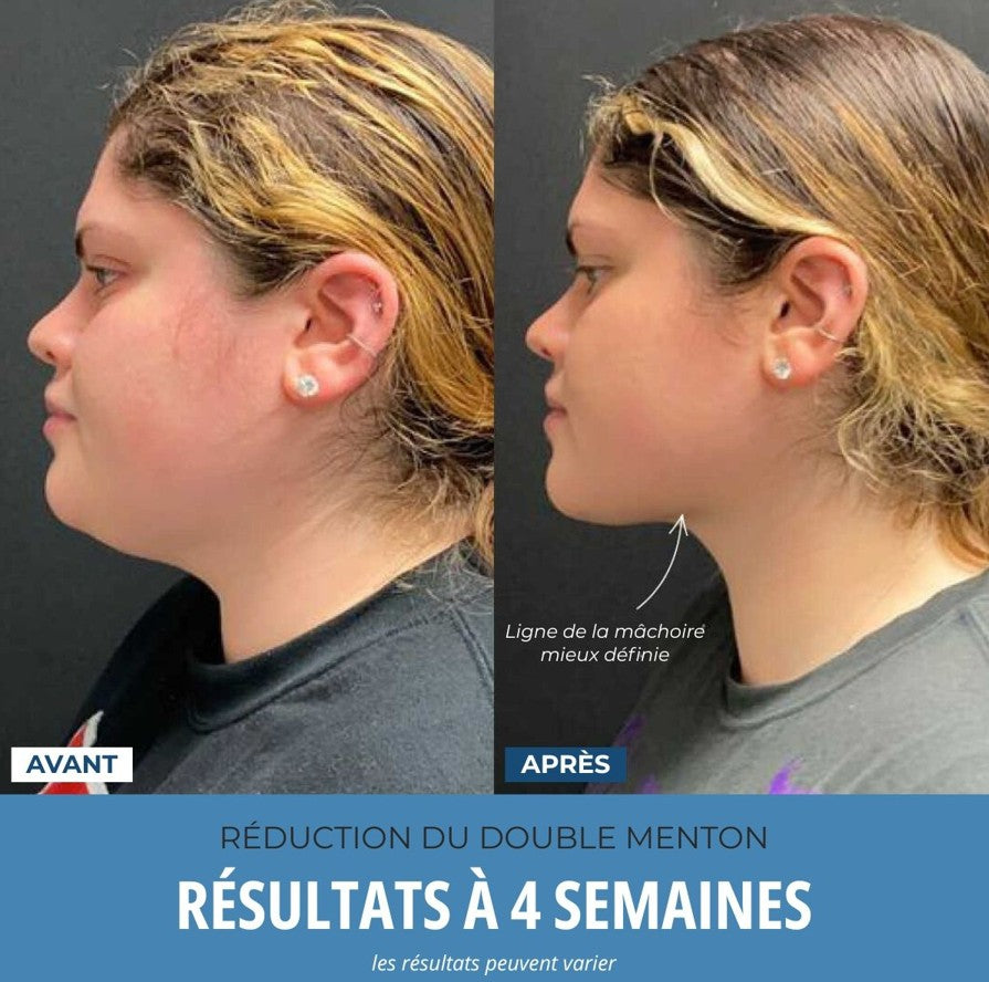 LumoSkyn Pro™ 2 - Sculpteur Visage et Cou